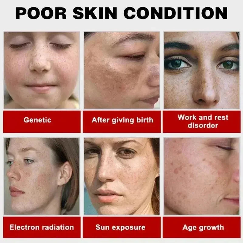 Whitening Freckles Face Cream Removal Melasma Dark Spots Corrector Lighten Melanin Pigmentation Brighten Anti-Aging Beauty Care