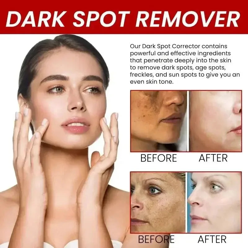 Whitening Freckles Face Cream Removal Melasma Dark Spots Corrector Lighten Melanin Pigmentation Brighten Anti-Aging Beauty Care