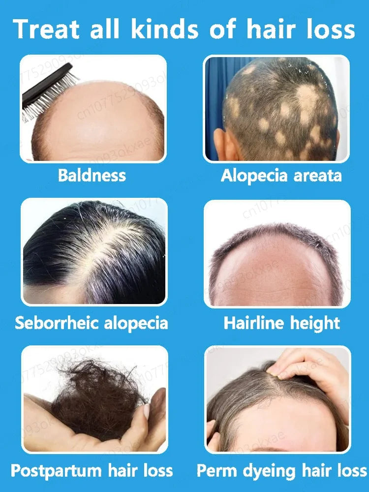Huile essentielle de croissance rapide des cheveux, répare la calvitie