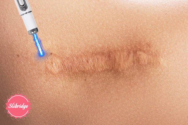 Laser therapy Keloid scar