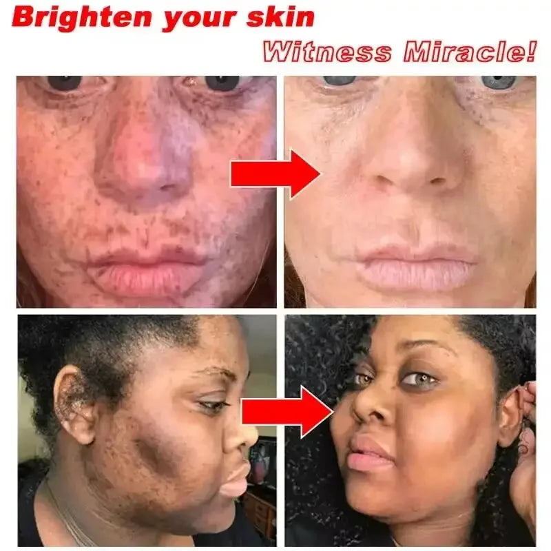 Whitening Freckles Face Cream Removal Melasma Dark Spots Corrector Lighten Melanin Pigmentation Brighten Anti-Aging Beauty Care