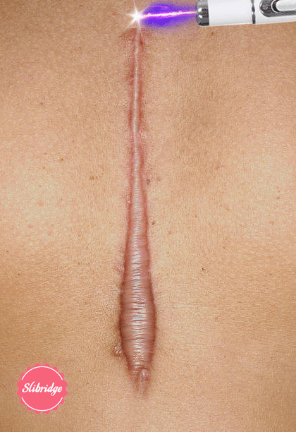 Laser therapy Keloid scar